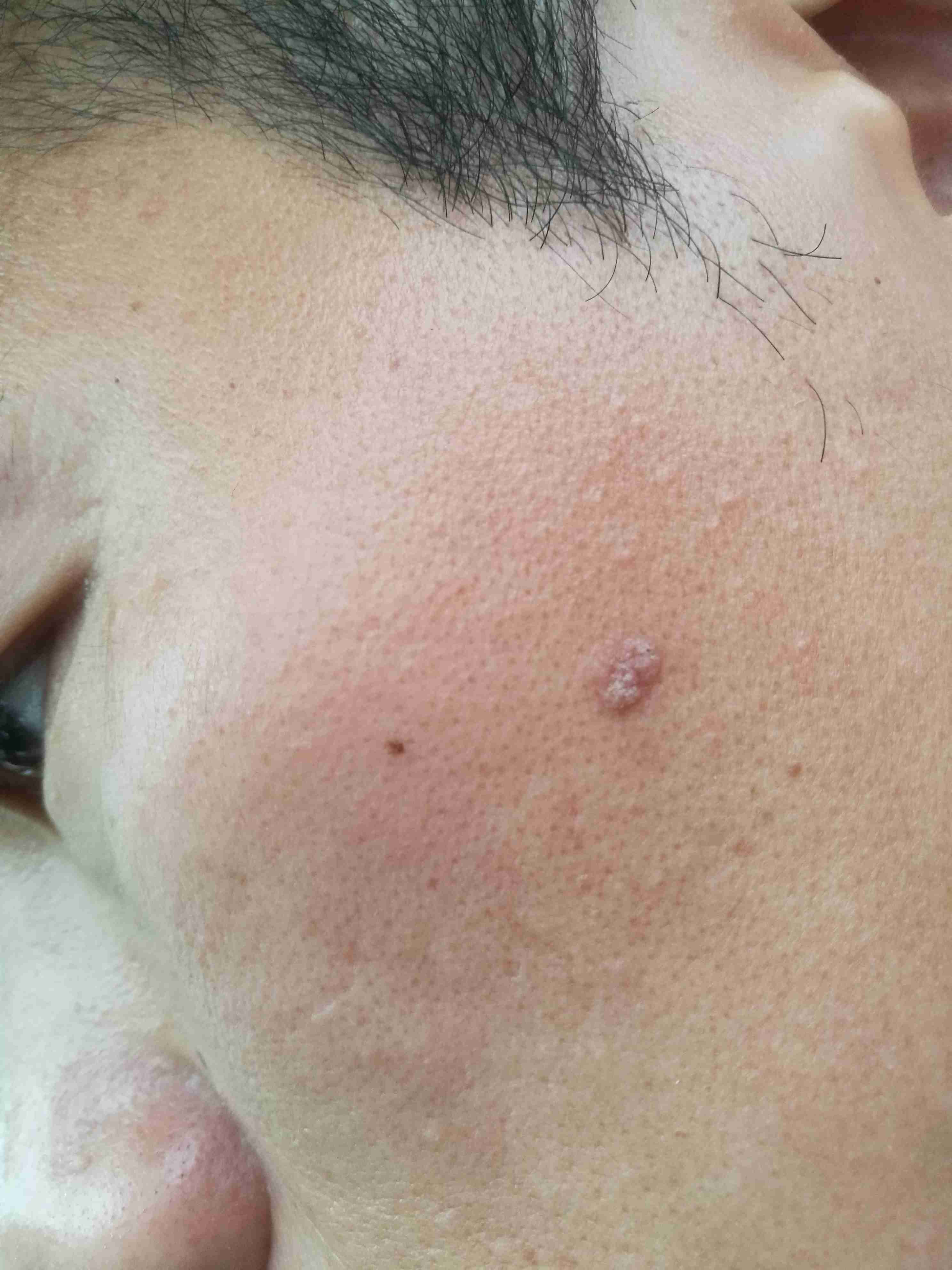 脸上有个肉疙瘩怎么去除