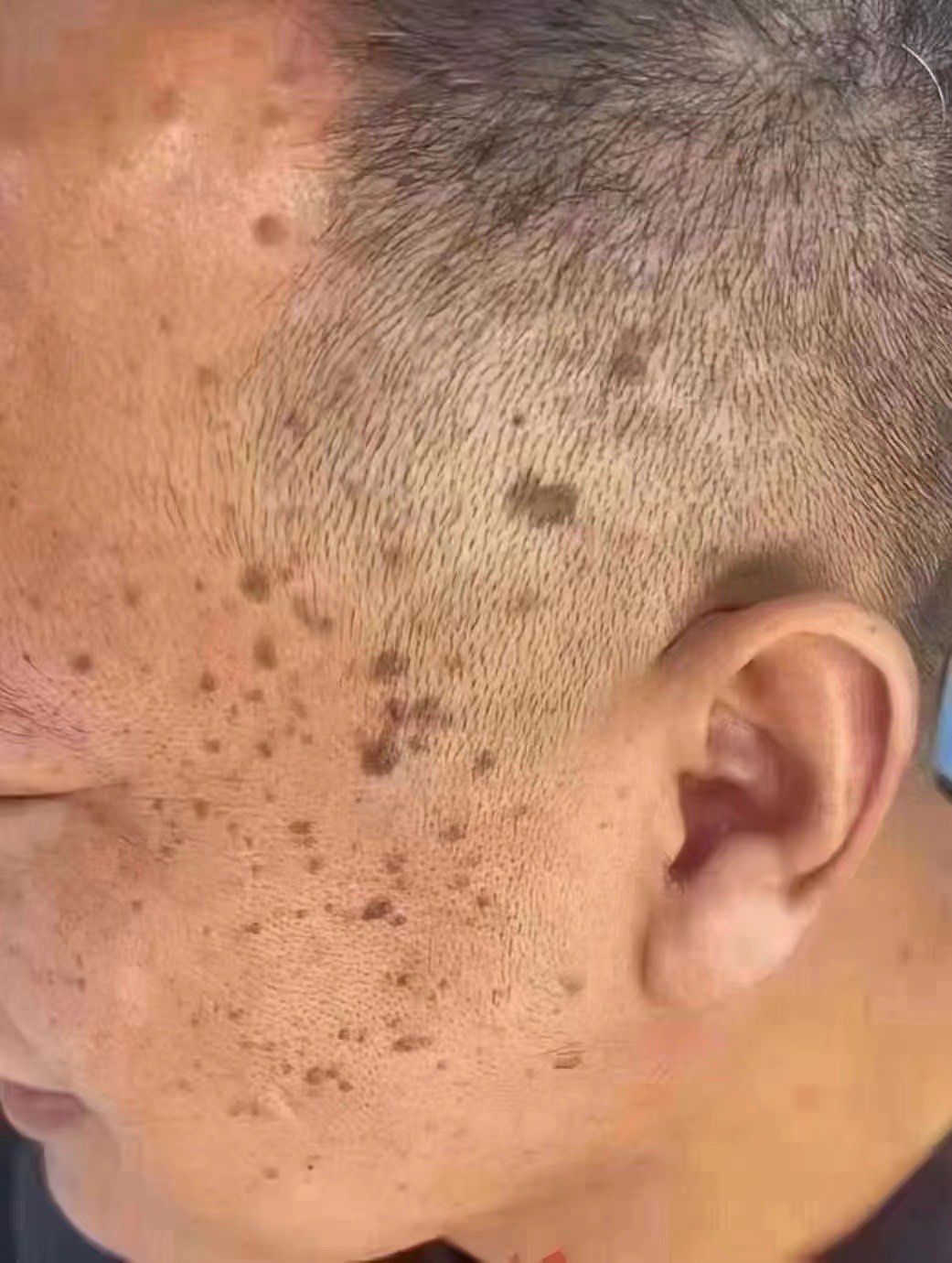 扁平疣会传染给别人吗