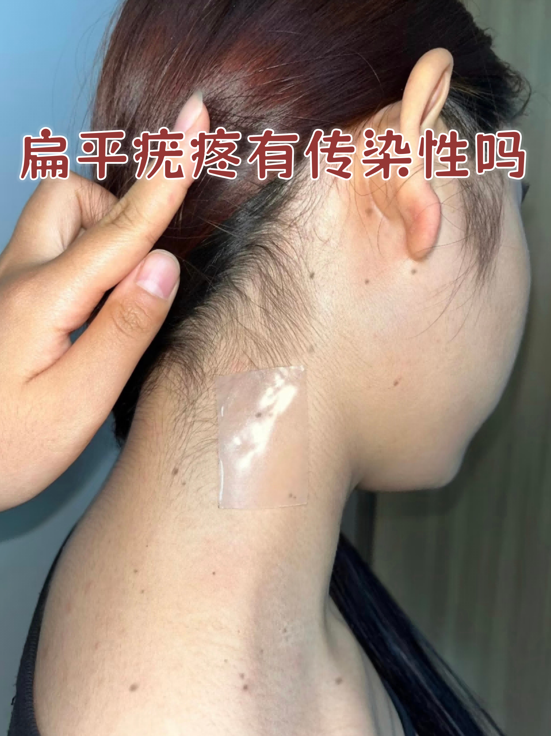 扁平疣会传染给别人吗