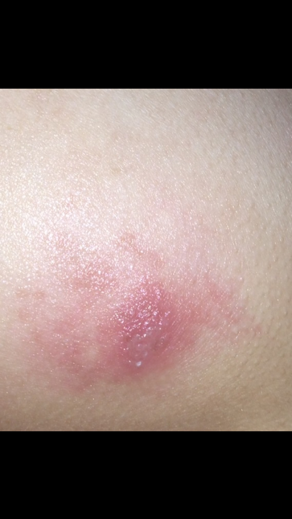 臀部瘙痒,有疙瘩状.