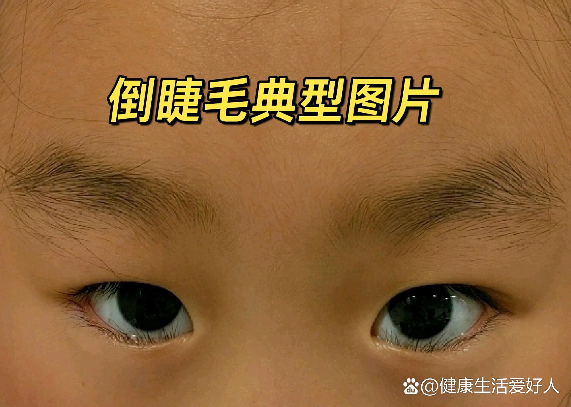 倒睫毛怎么处理