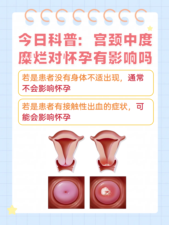 宫颈糜烂分几级