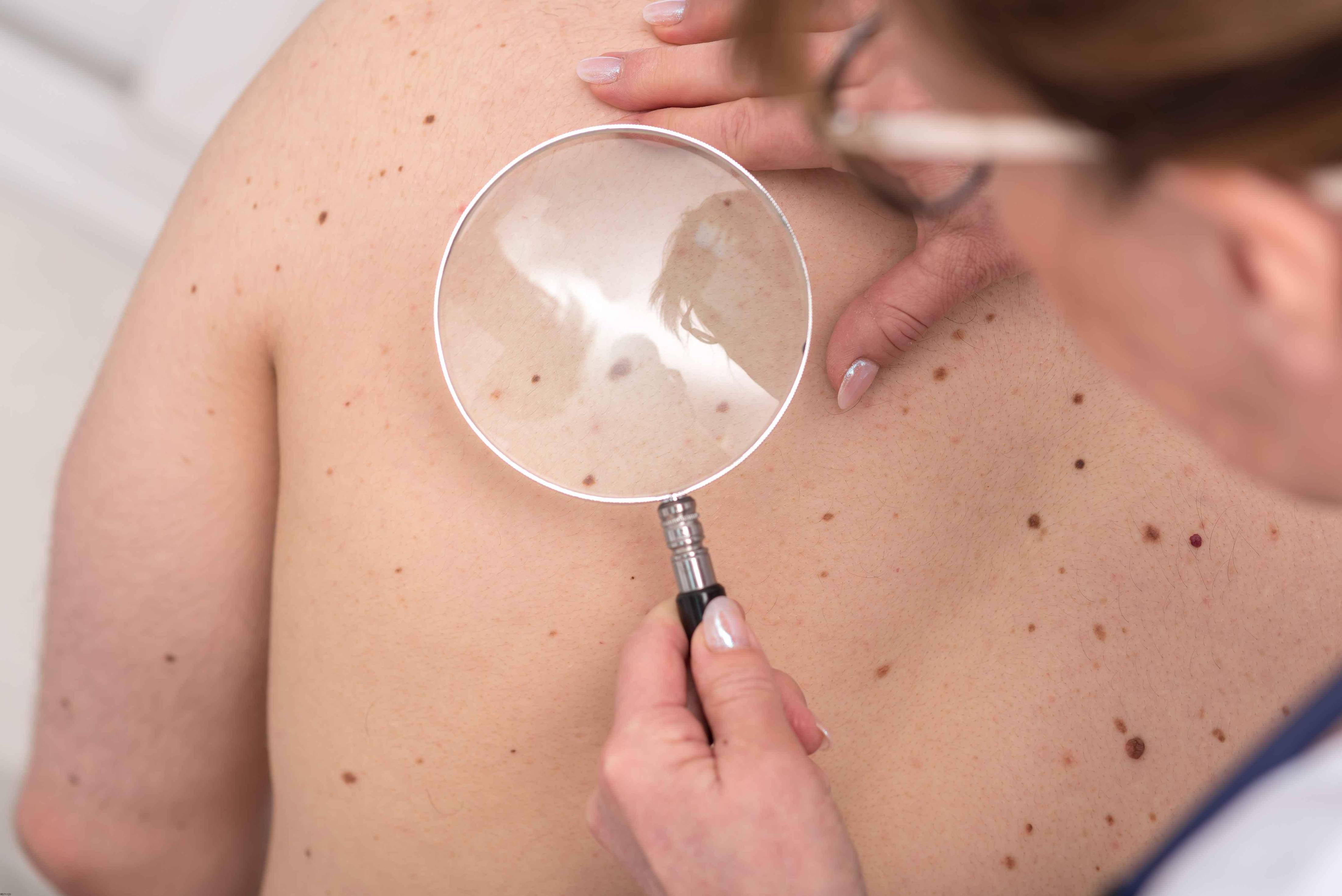 腋下长小肉粒怎么回事