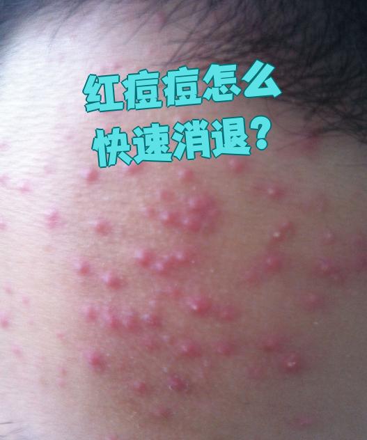 脸上长红痘痘,怎么办?