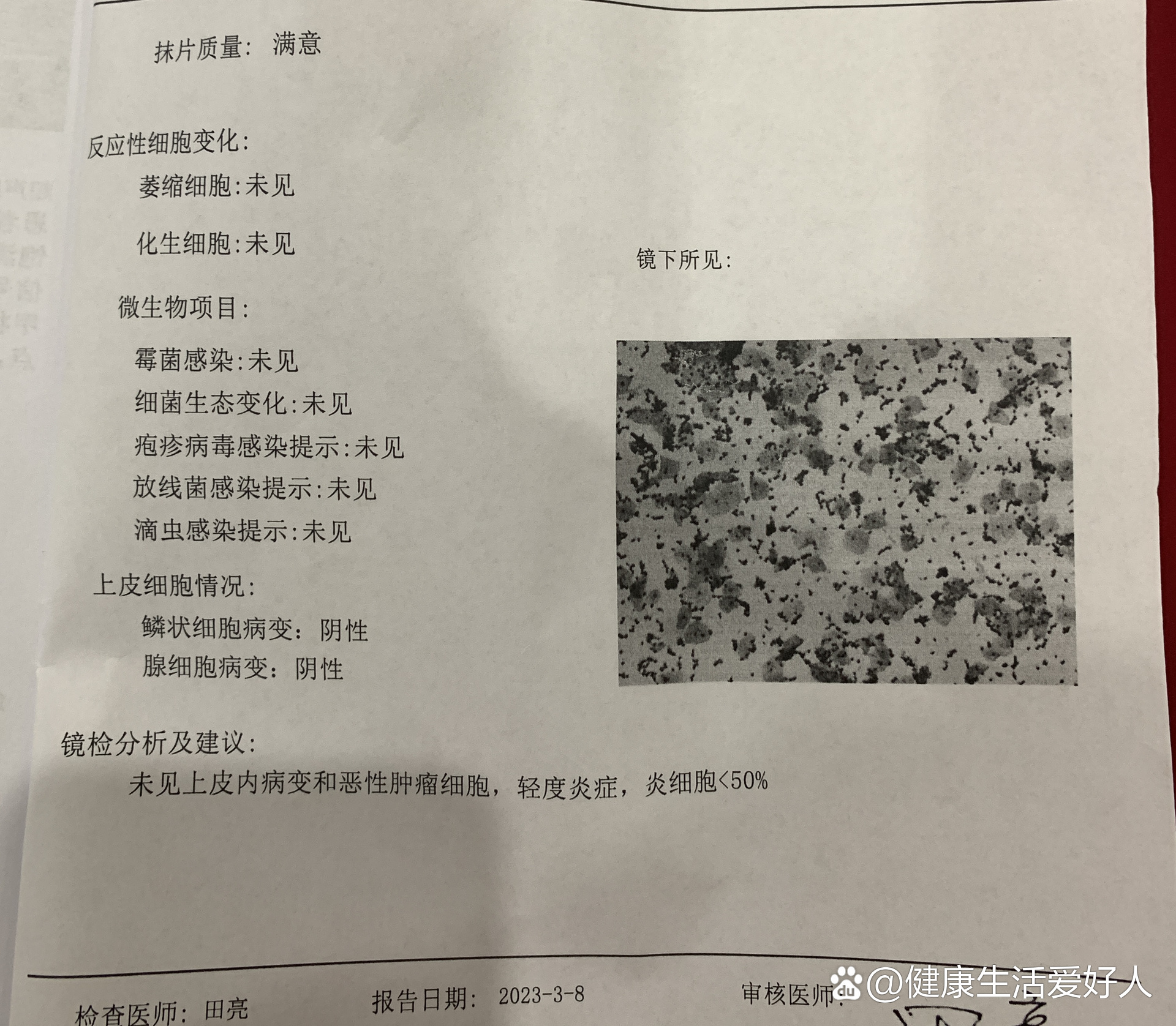 TCT检查是什么意思