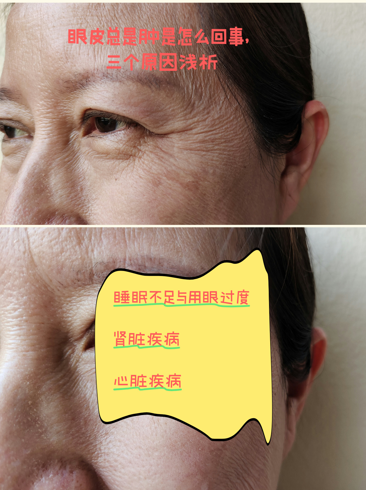 一只眼上眼皮肿了,怎么回事