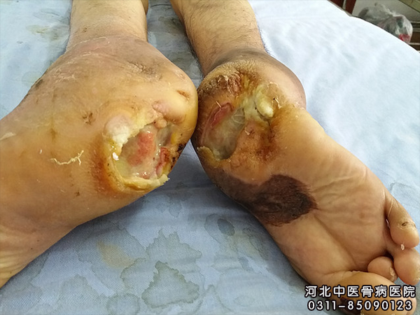 什么叫急性骨髓炎