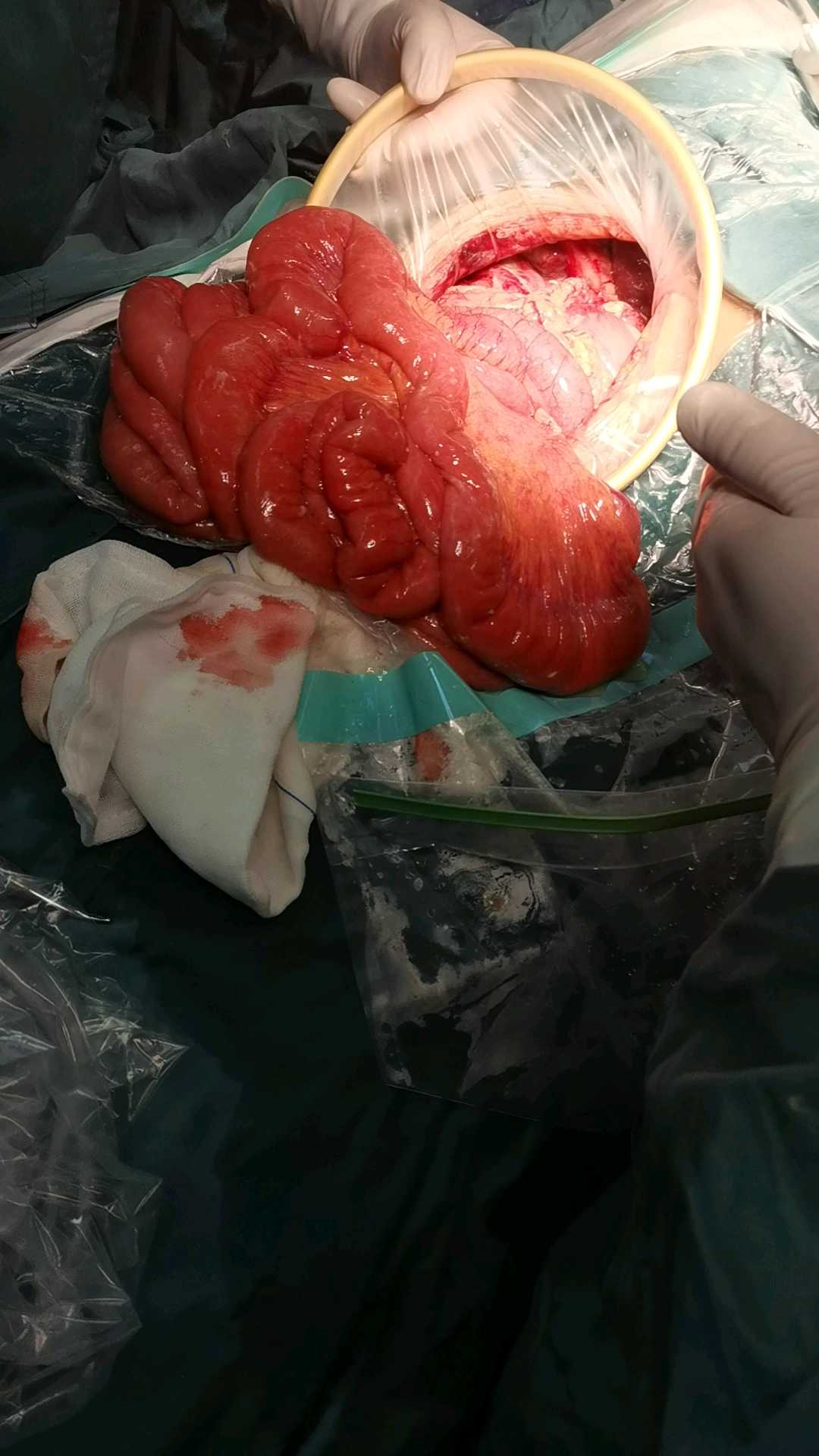 阑尾穿孔,严重吗??