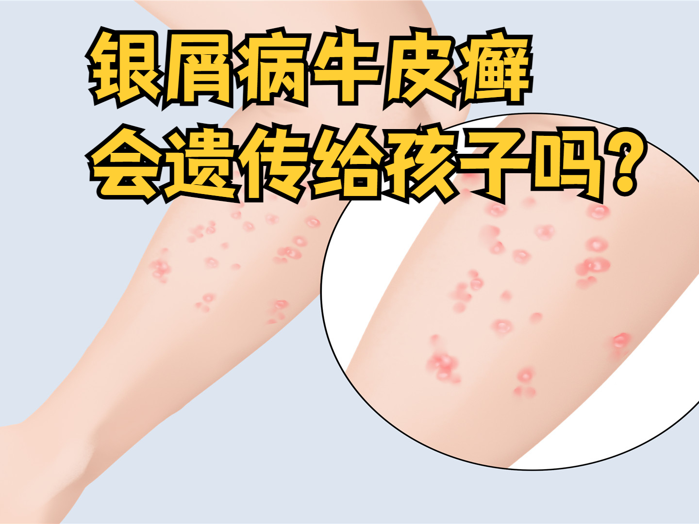 牛皮癣会遗传的吗