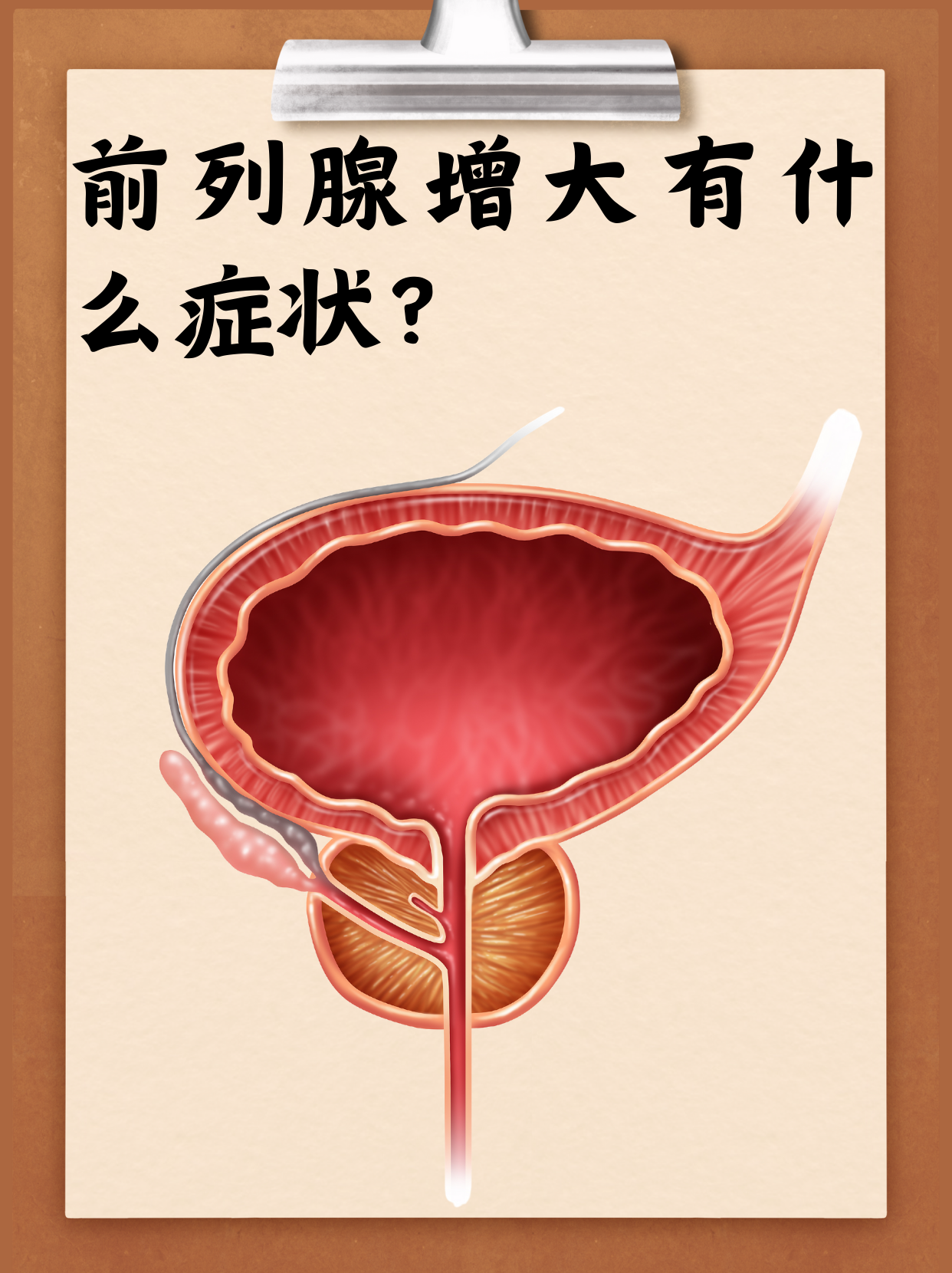 前列腺肥大的症状有哪些