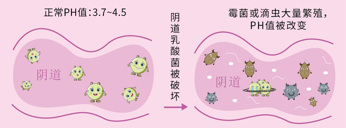 霉菌性阴道炎怎样治疗