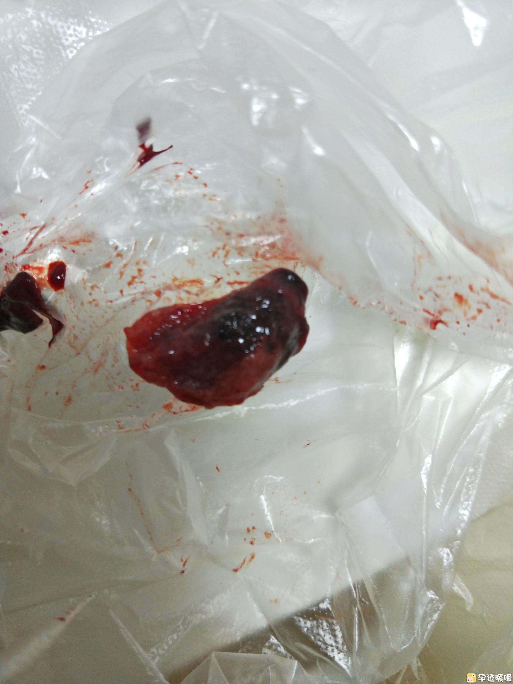 人流不干净的症状有哪些