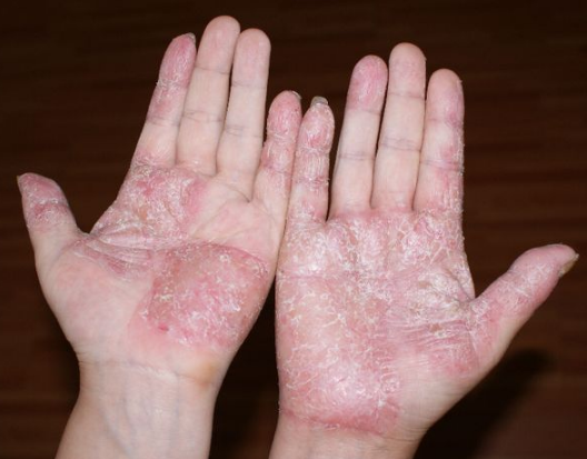 手脱皮是缺少什么维生素