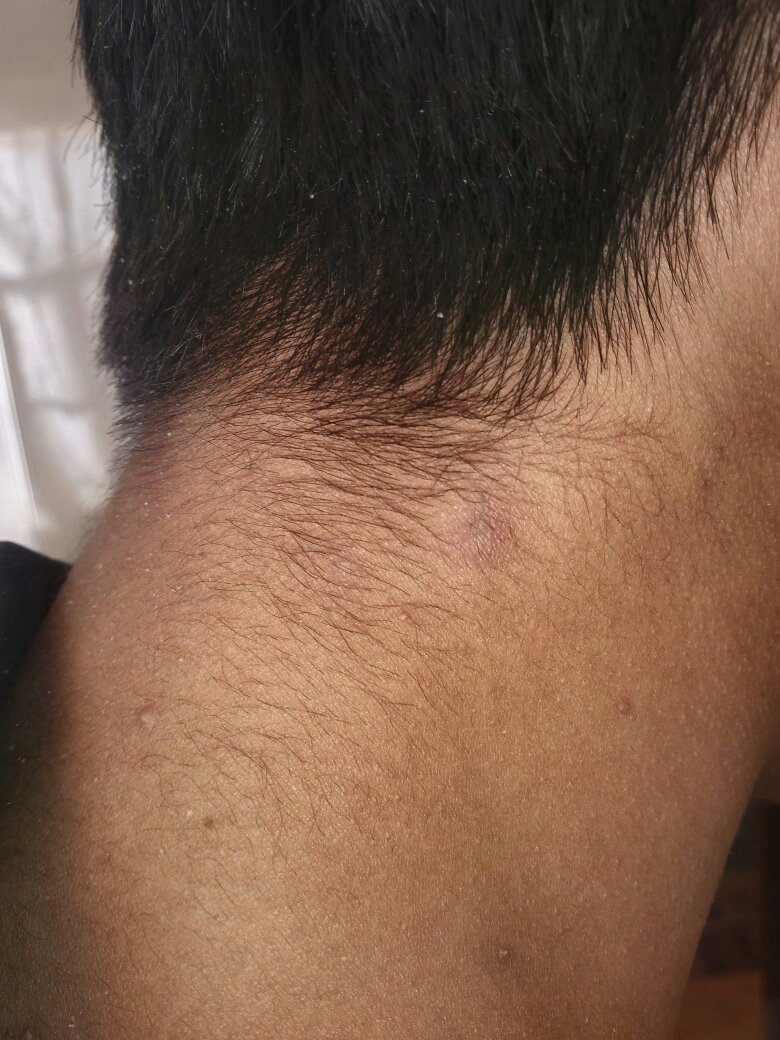 脖子后面长了个硬包这是什么