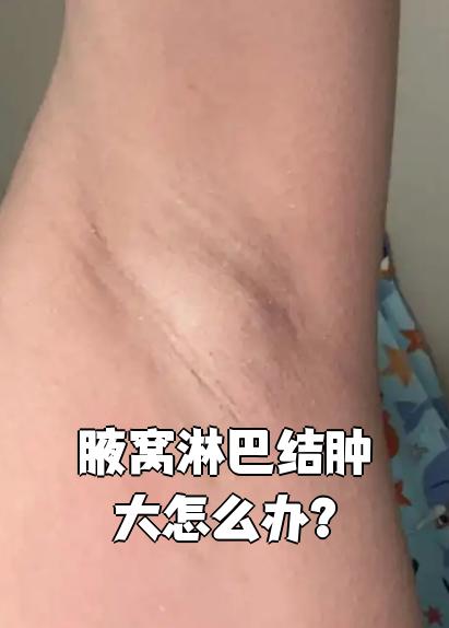 双侧腋窝淋巴结肿大是怎么回是