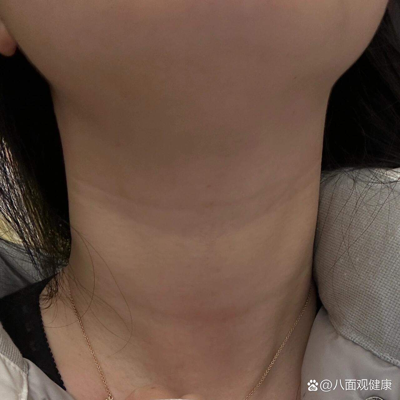 桥本氏病甲状腺炎严重吗?