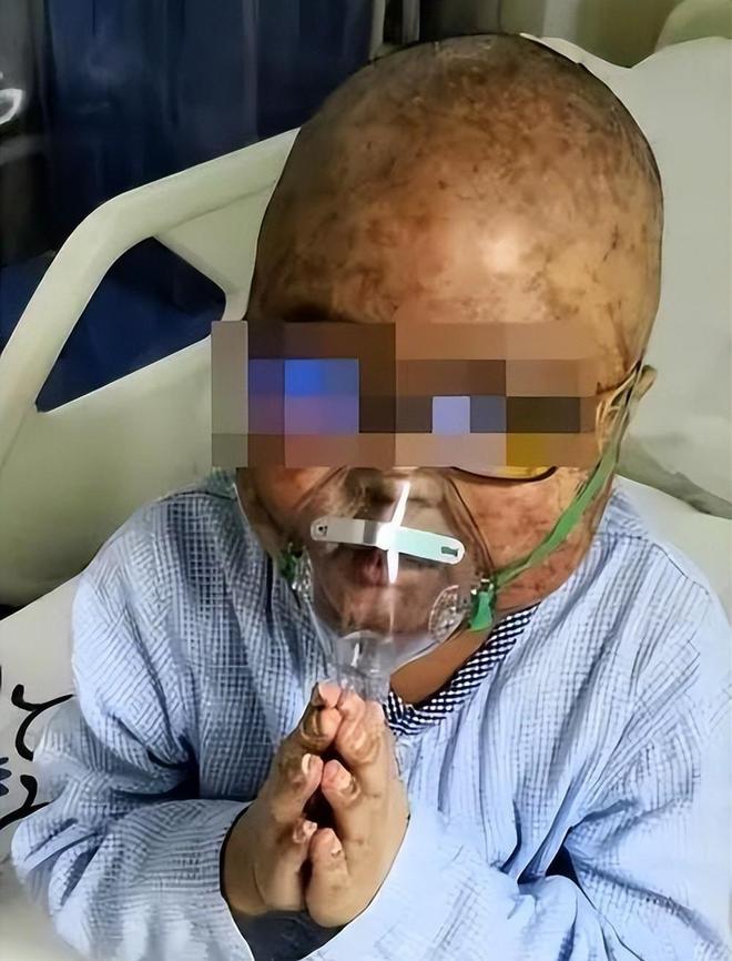 儿童白血病的早期症状有哪些?