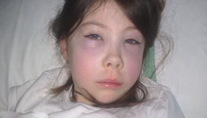 儿童白血病的早期症状有哪些?