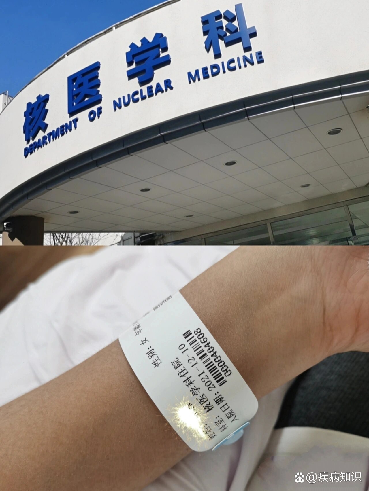 碘131治疗后隔离多久