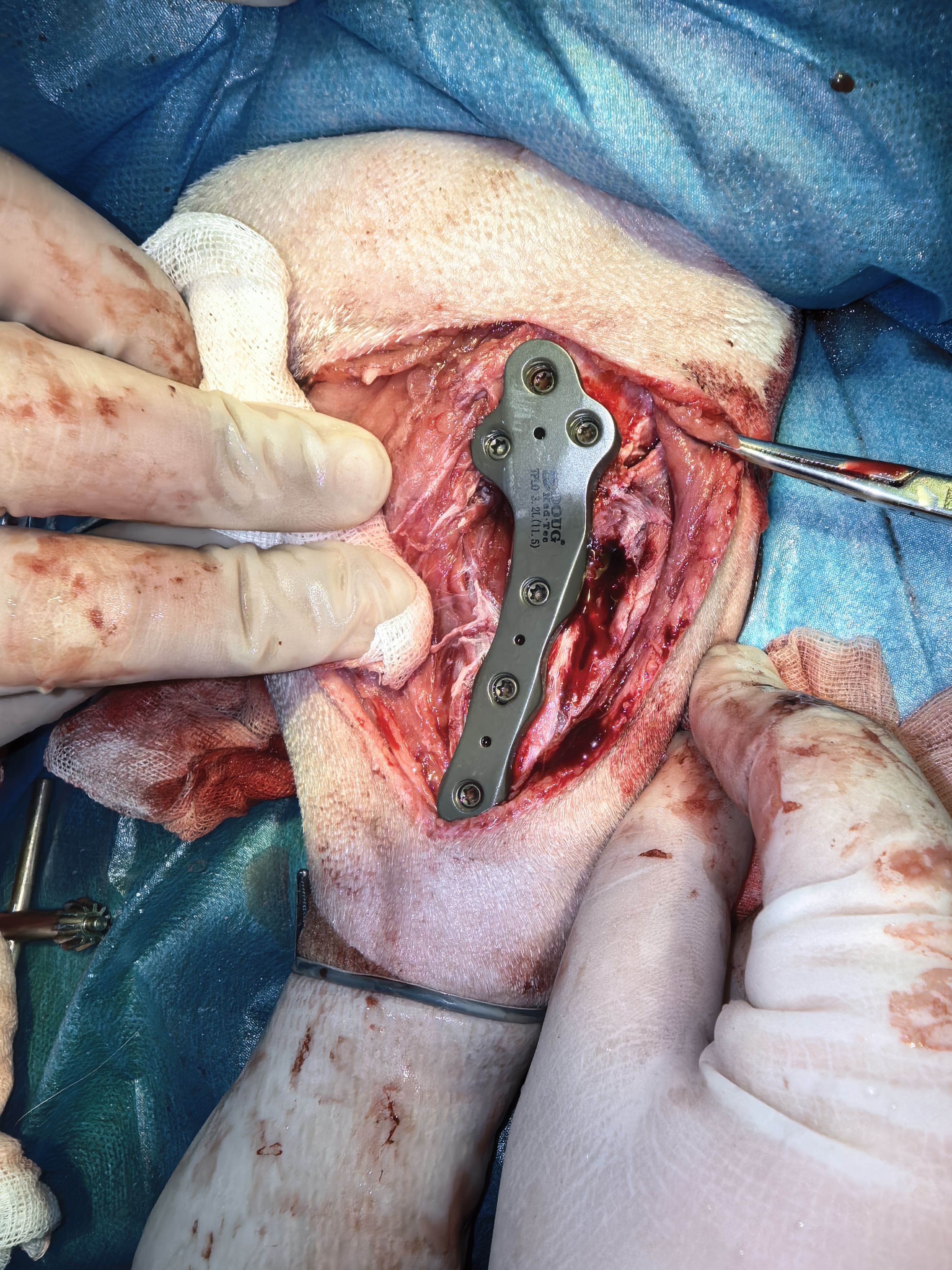 韧带断裂手术费用要多少