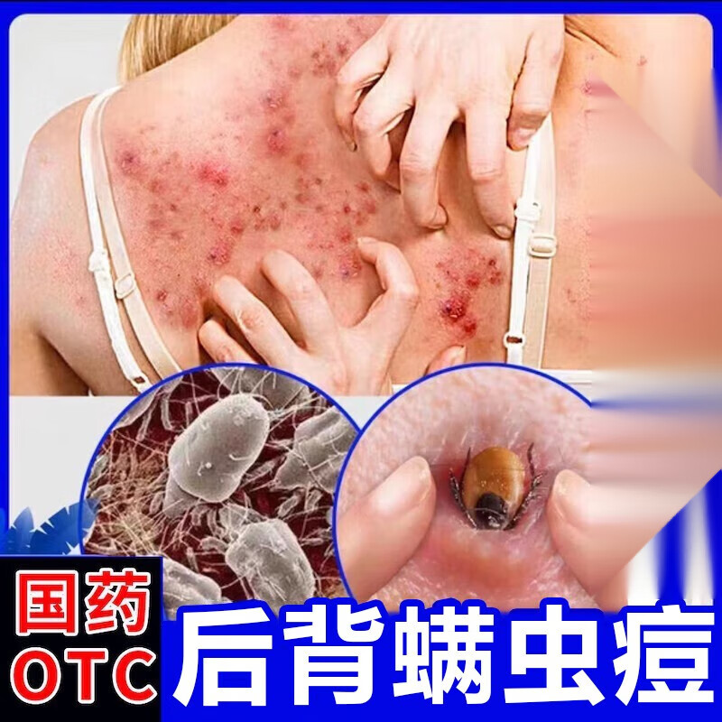 螨虫咬了涂什么药膏见效快