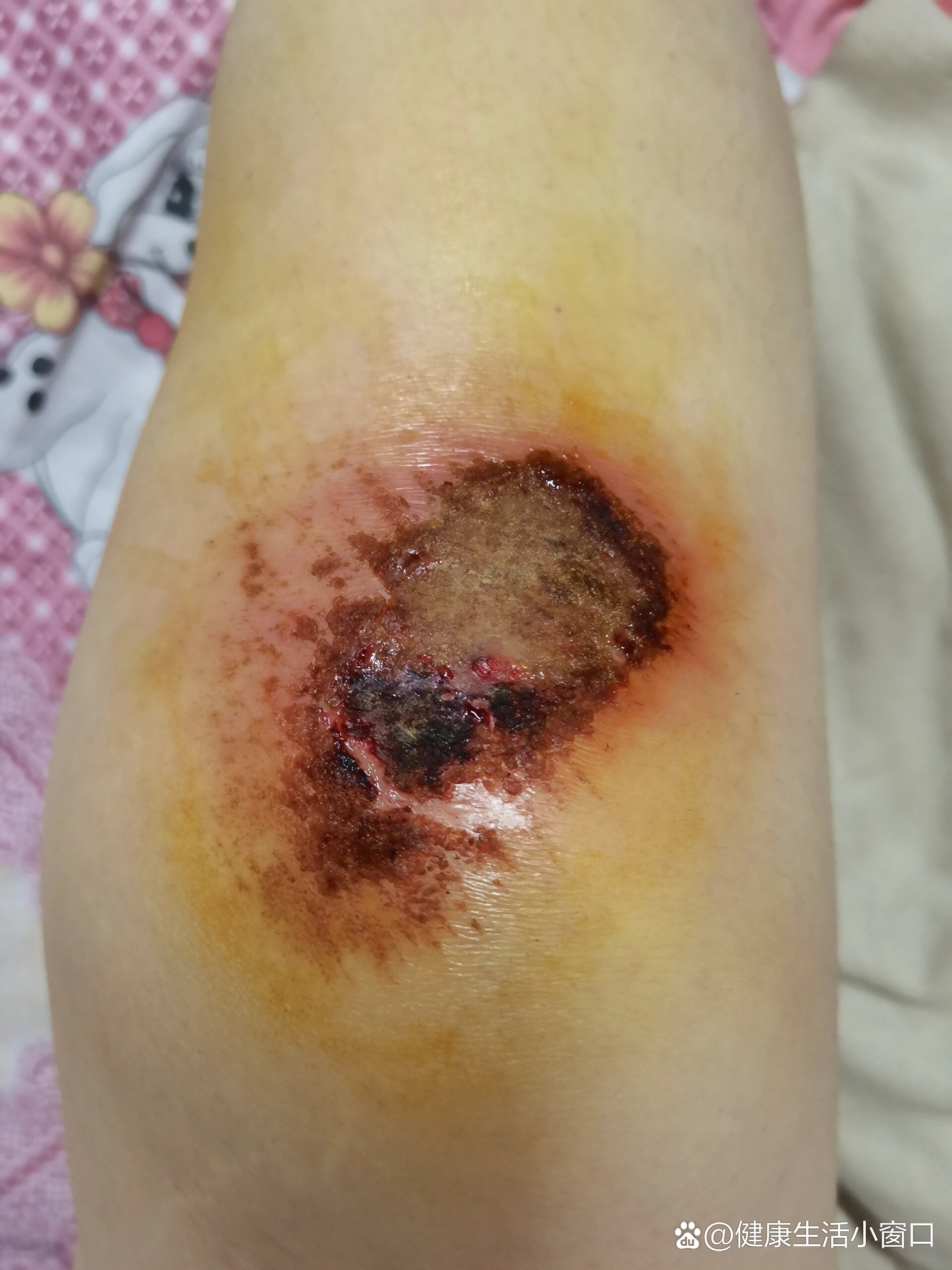 红霉素软膏可以直接涂在伤口上吗