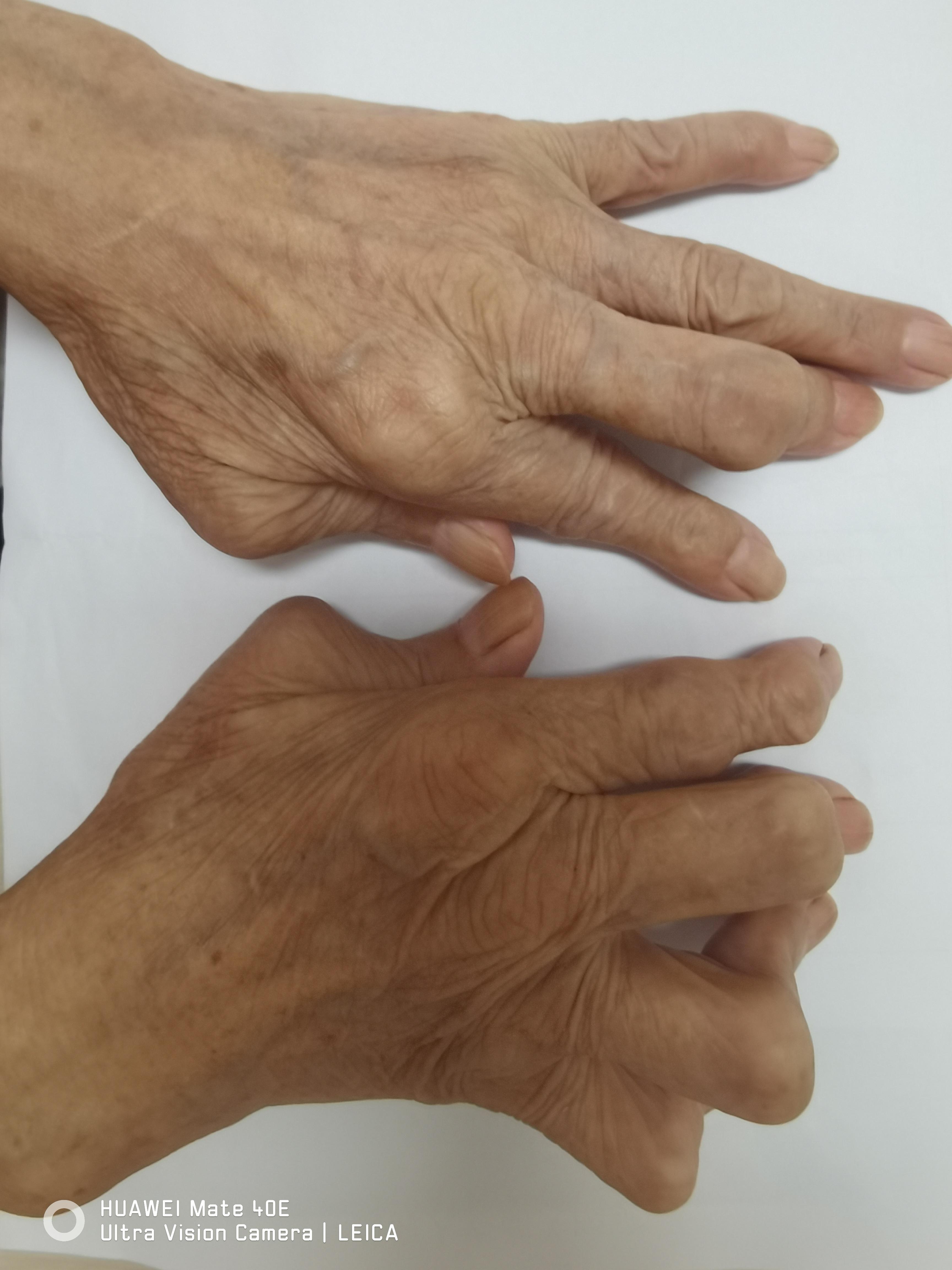 风湿病早期的症状