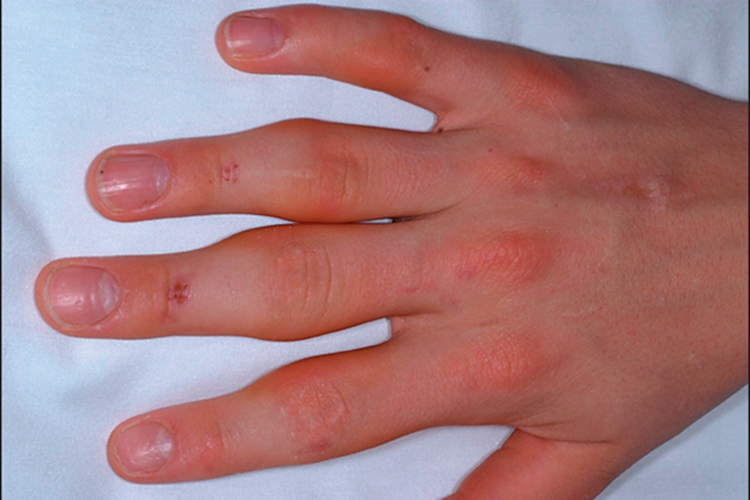 风湿病早期的症状