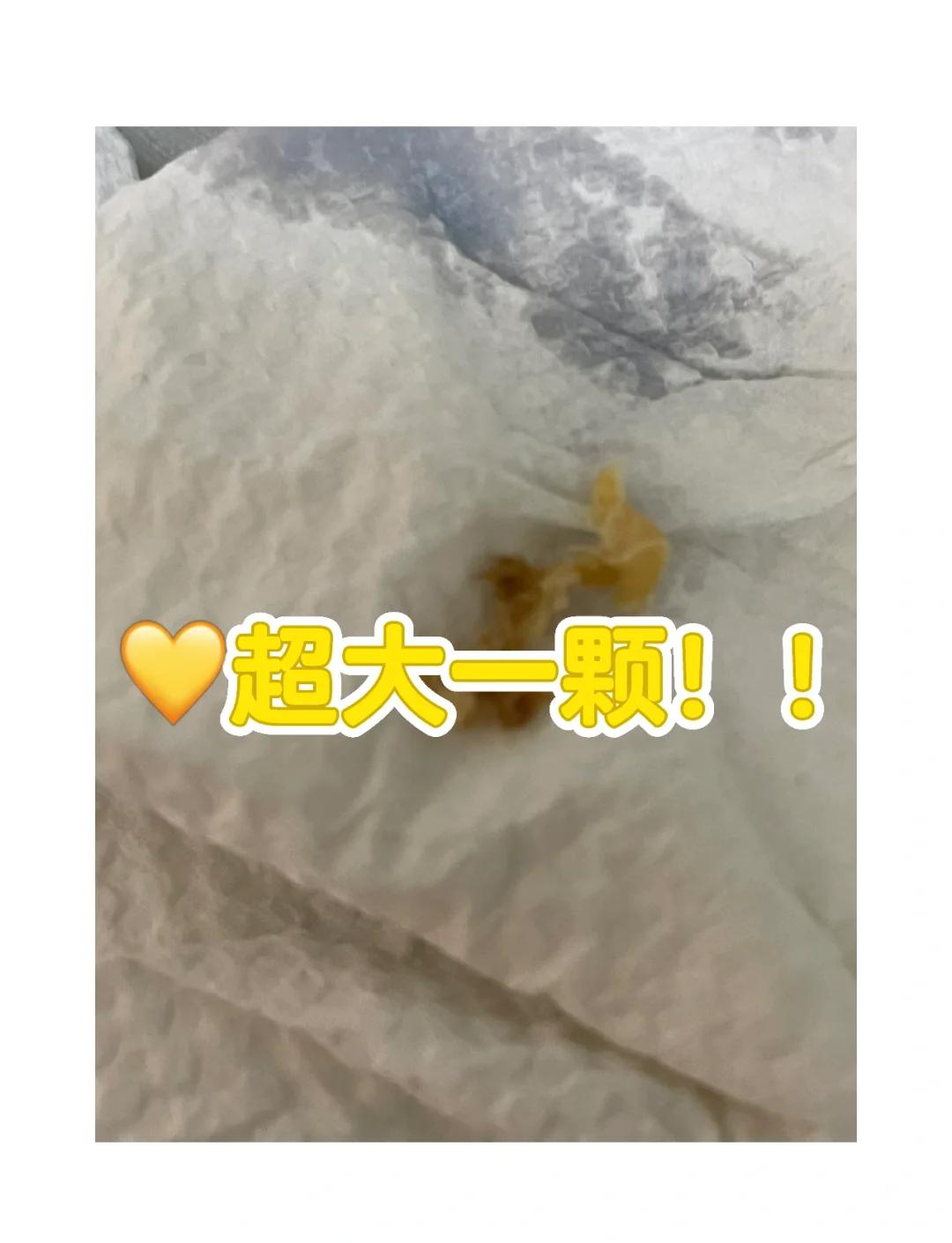 耳朵里面有耳屎硬了挖不出来怎么办