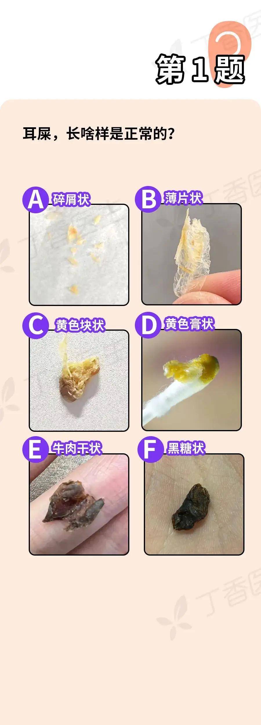 耳朵里面有耳屎硬了挖不出来怎么办