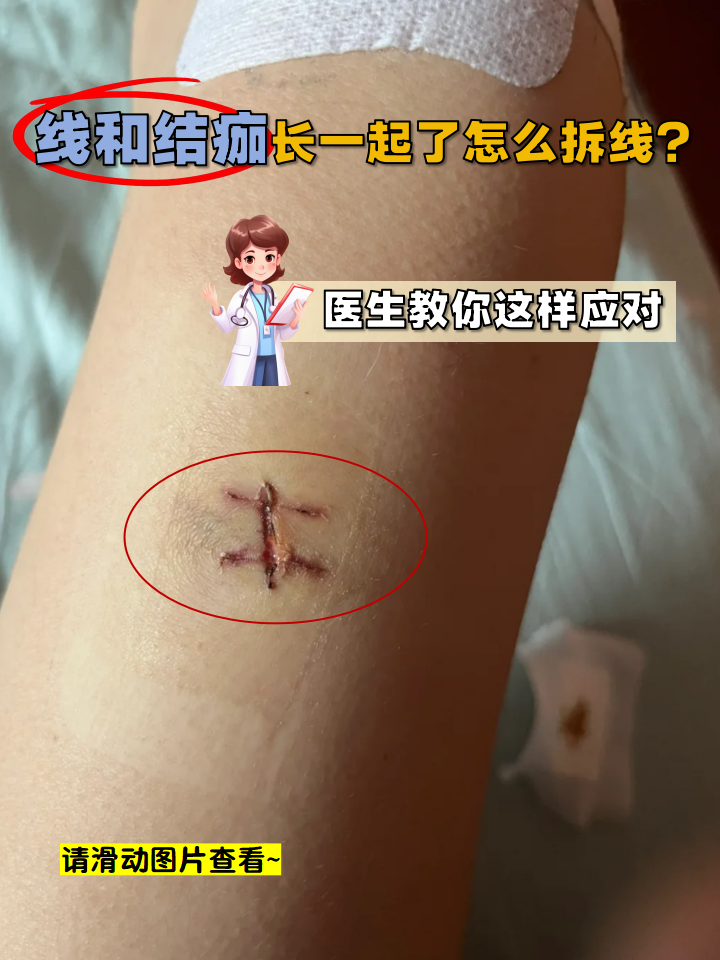 自己拆线后需要注意什么