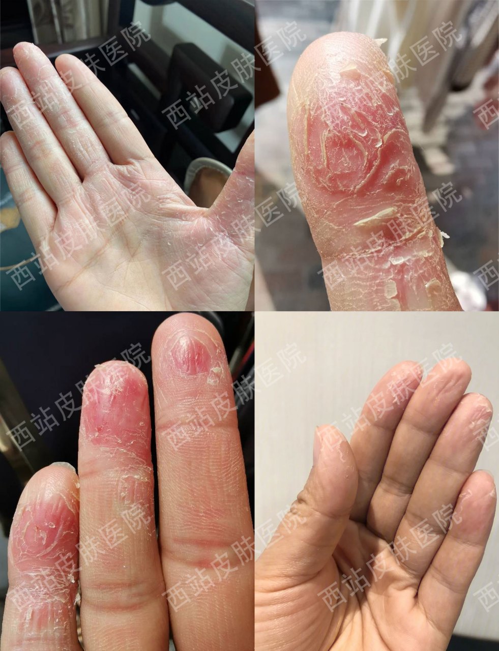手指皮肤角质化脱皮开裂