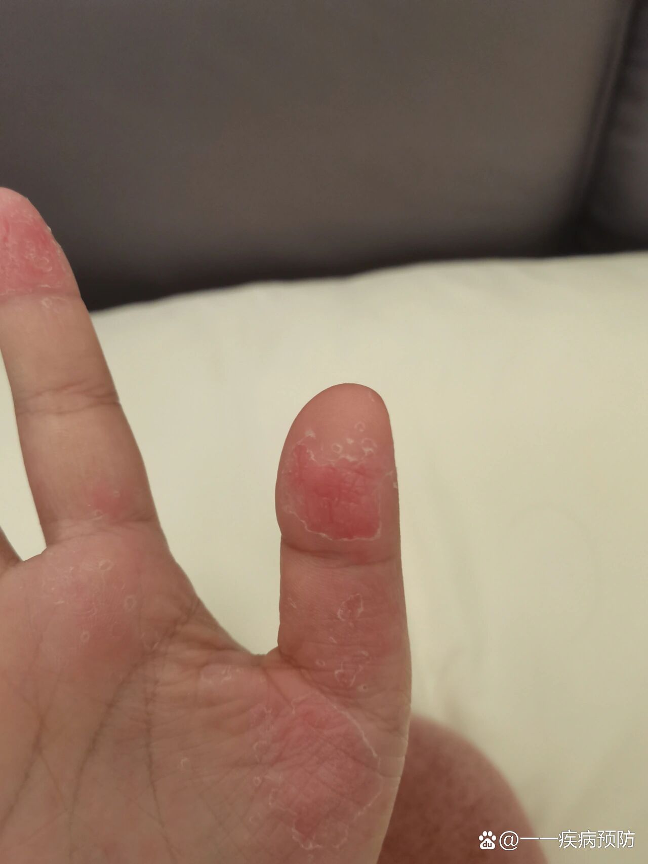 手指皮肤角质化脱皮开裂
