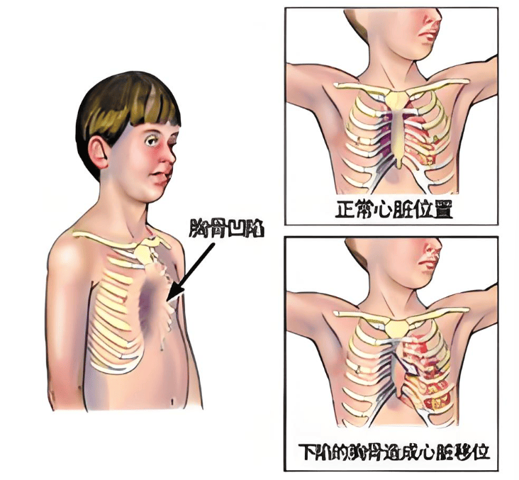 我的胸正常吗,有没有鸡胸