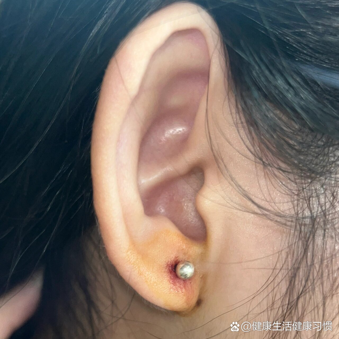 打完耳洞流血怎么办