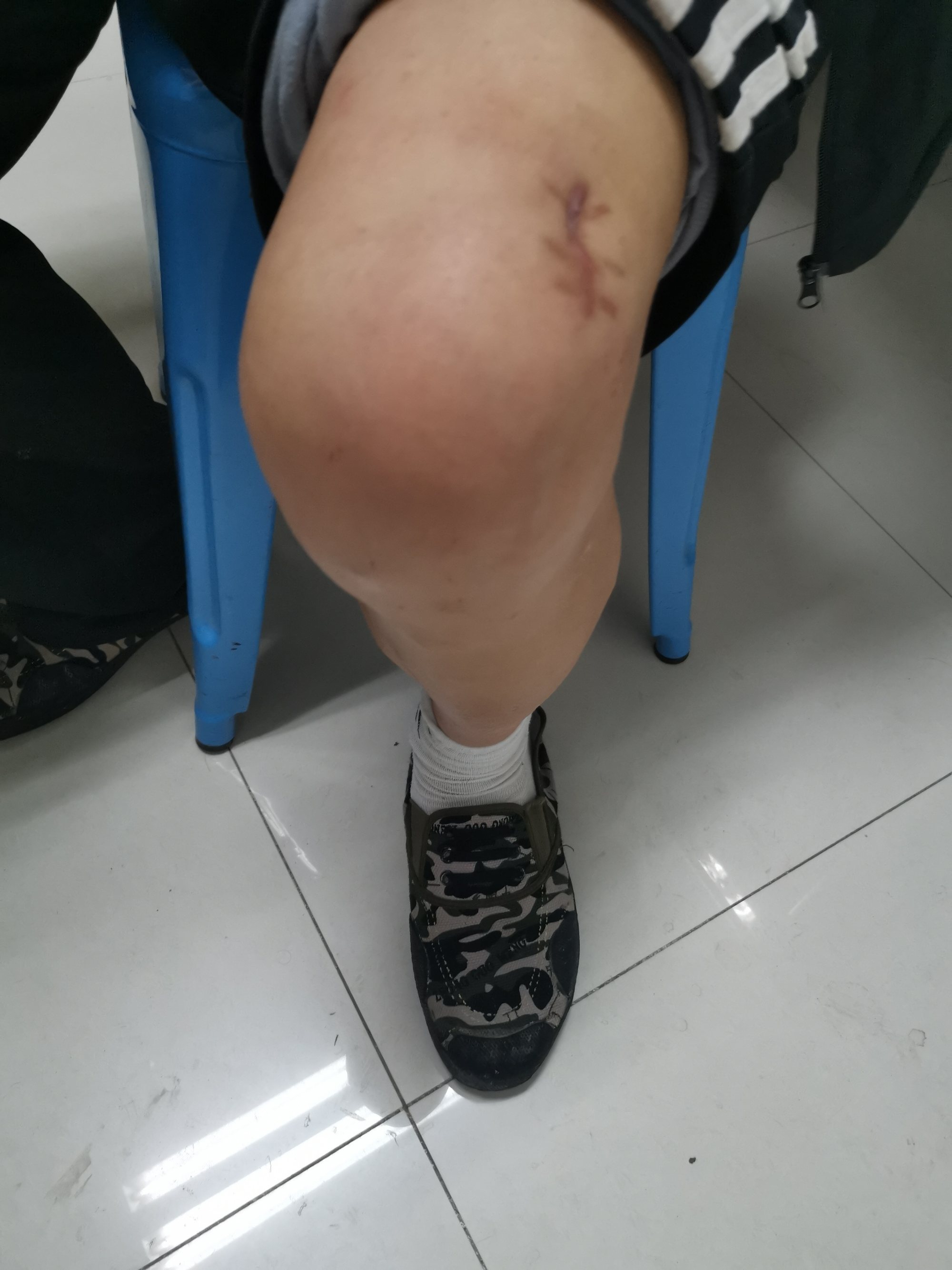 患者膝盖积水是什么症状