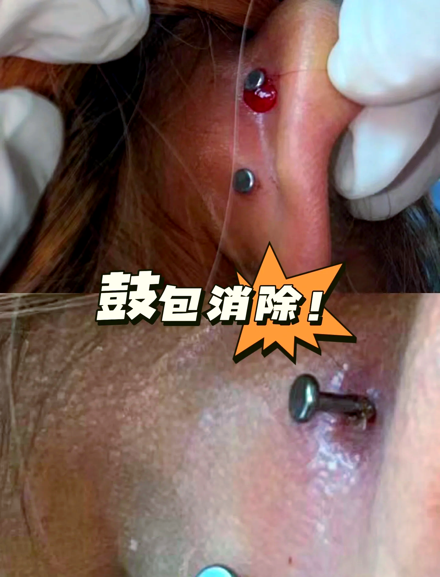 打了耳洞肿了怎么办