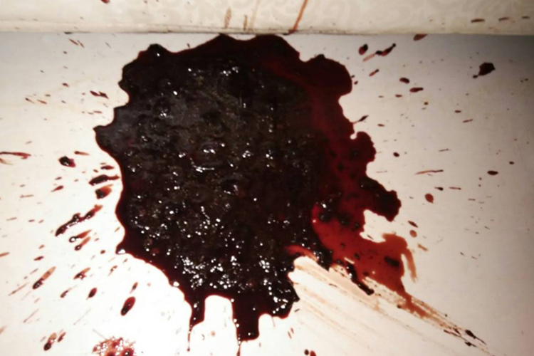 消化道大出血是什么样子的