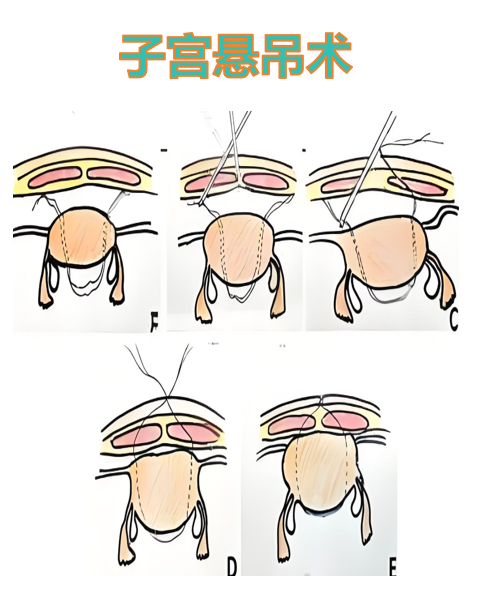 子宫下垂怎么治疗比较好医生