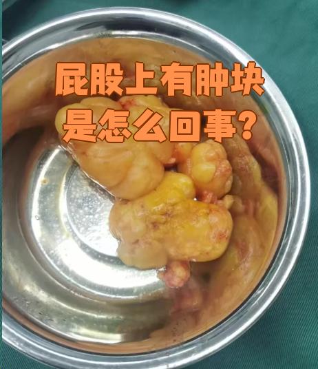 屁股上有硬块是怎么回事