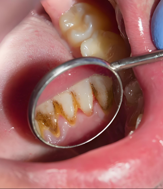 牙缝很臭是怎么回事