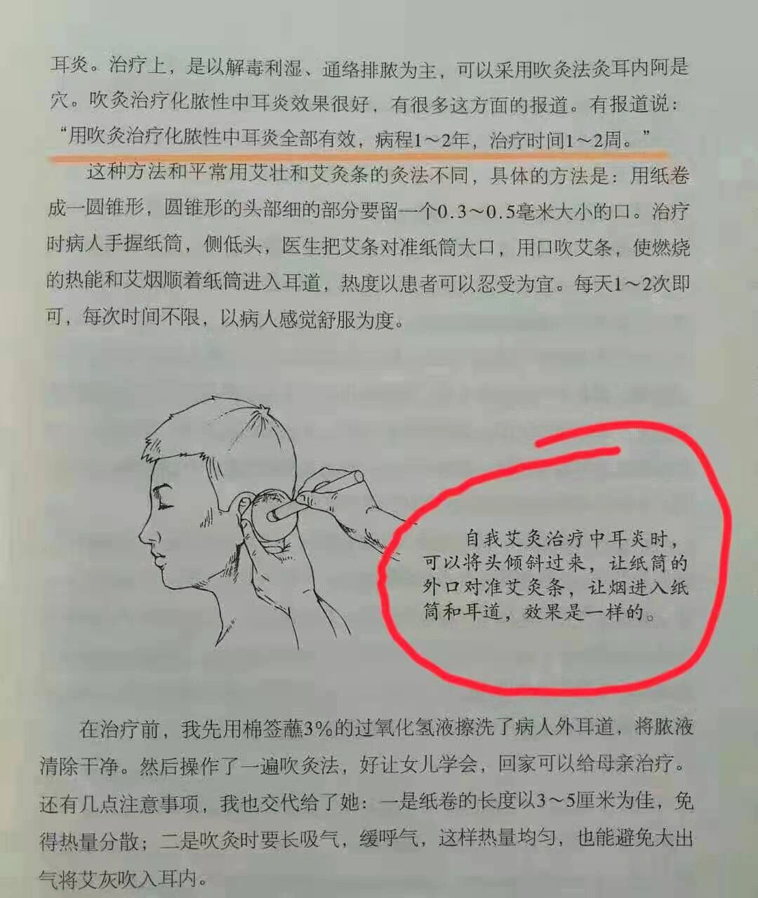 中耳手术后注意事项