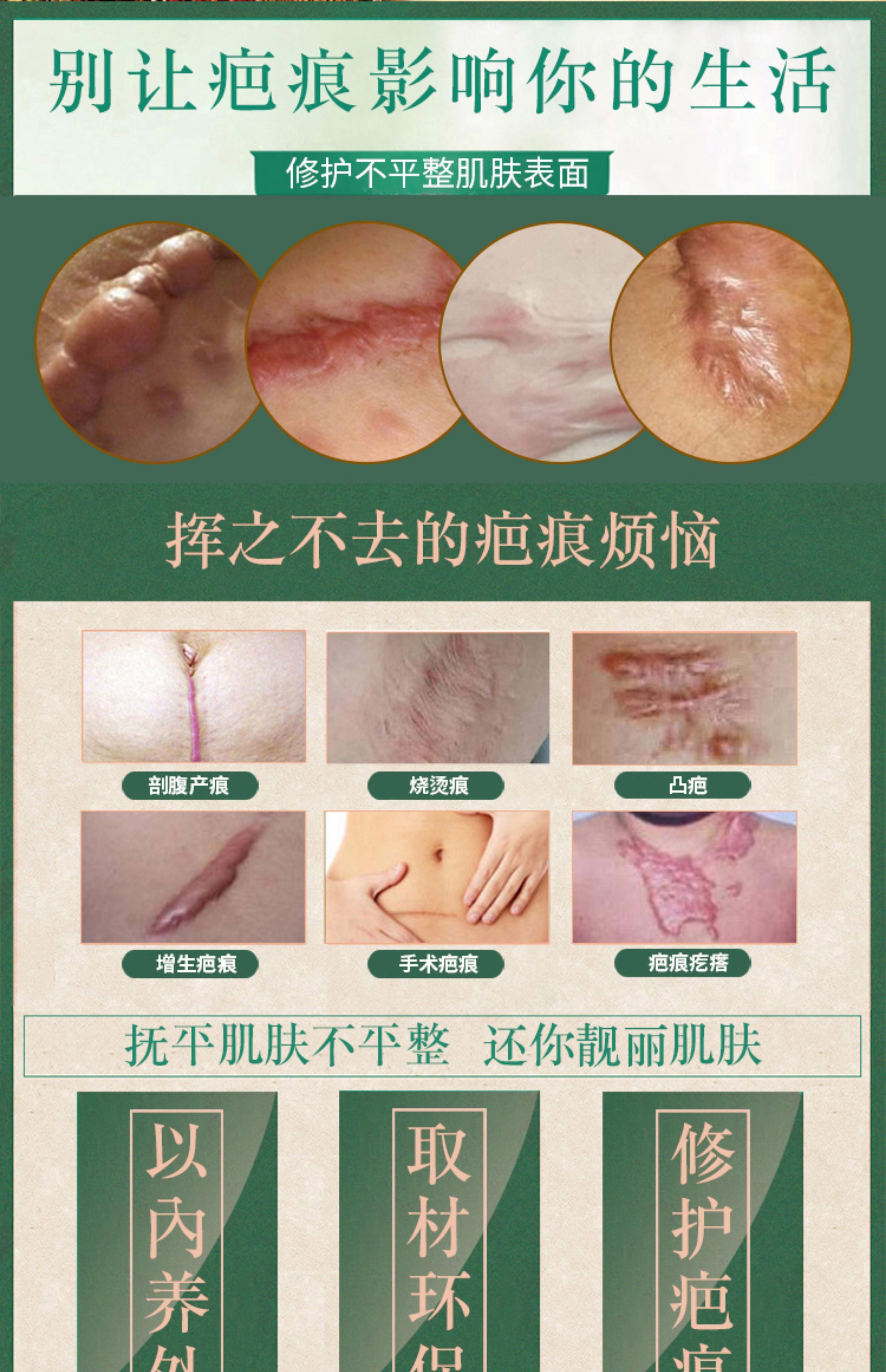 瘢痕疙瘩抹什么药膏