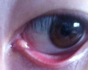 右眼内眼角疼一眨眼或者用手一按更疼