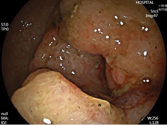 大肠癌的晚期症状有哪些?