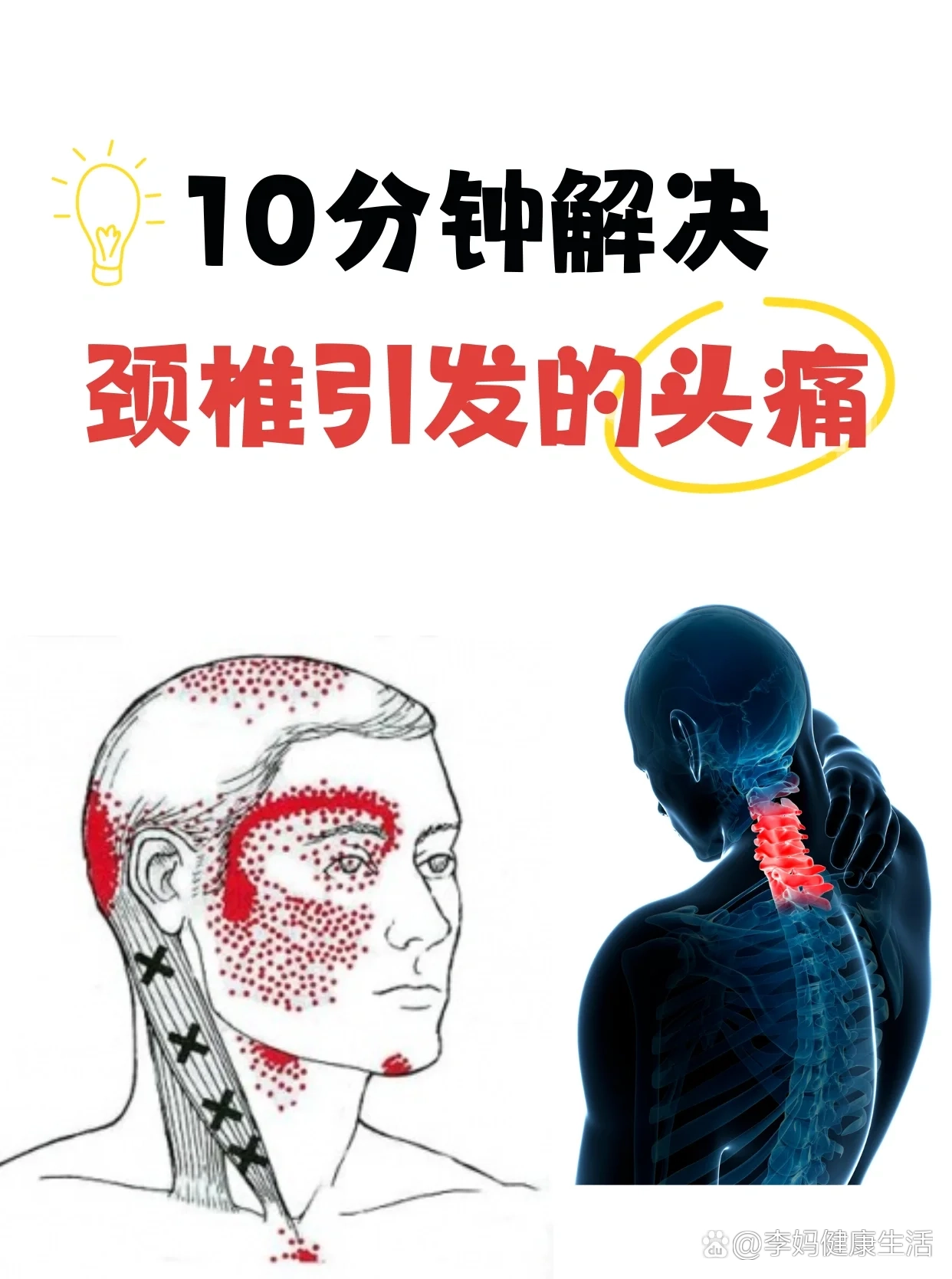 颈椎病会引起头痛吗?