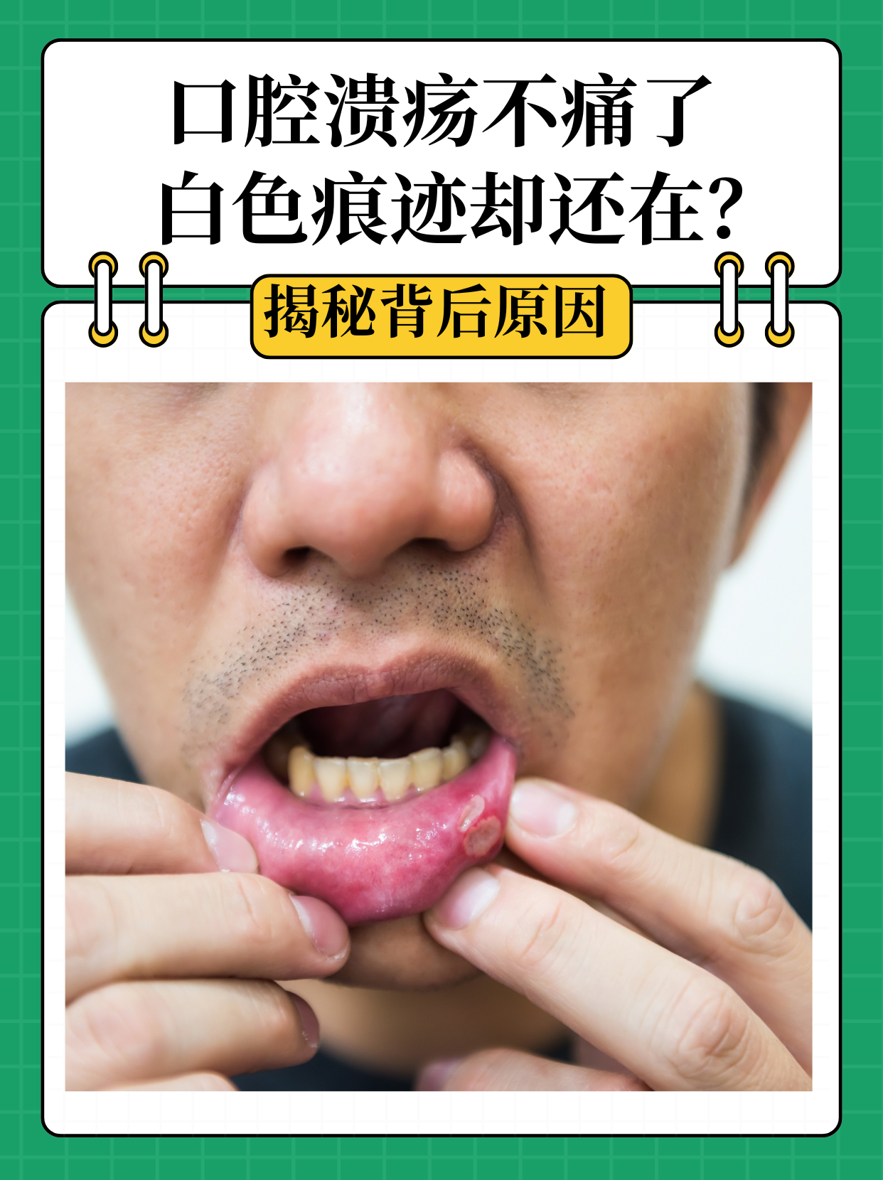 口腔溃疡是艾滋病吗?