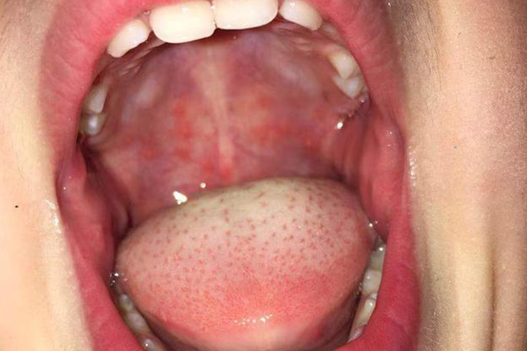 疱疹性咽炎的症状有哪些