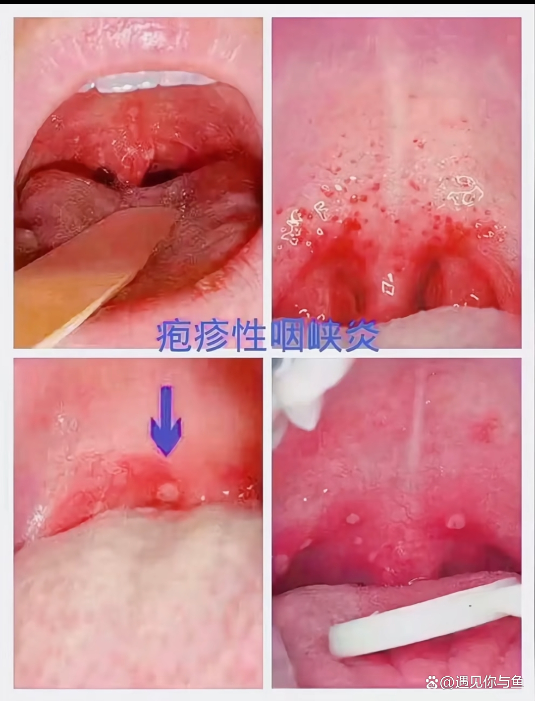 疱疹性咽炎的症状有哪些