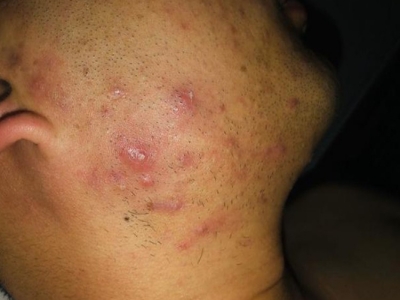 艾滋病有哪些症状